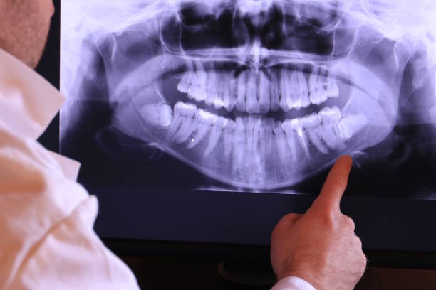 Best Knocked-Out Tooth (Avulsed Tooth) Treatment in Derma, MS